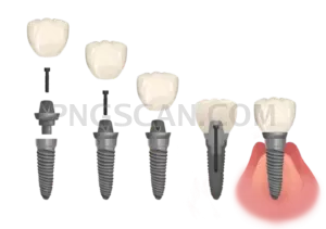 Dental Implant #339 cutout from Dental Implant
