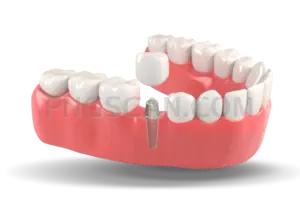 Dental Implant #333 cutout from Dental Implant