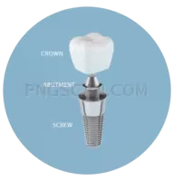 Dental Implant #337 cutout from Dental Implant