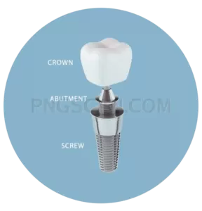 Dental Implant #337 cutout from Dental Implant