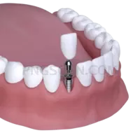 Dental Implant #346 cutout from Dental Implant
