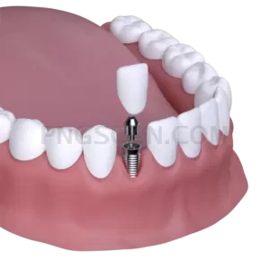 Dental Implant #346 cutout from Dental Implant
