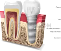 Dental Implant #349 cutout from Dental Implant