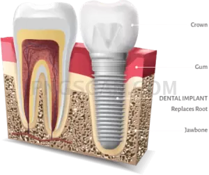 Dental Implant #349 cutout from Dental Implant