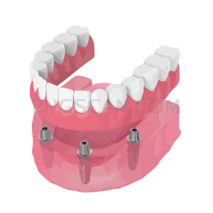Dental Implant #352 cutout from Dental Implant