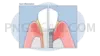 Dental Implant #360 cutout from Dental Implant