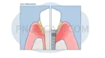 Dental Implant #360 cutout from Dental Implant