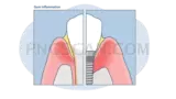Dental Implant #360 cutout from Dental Implant