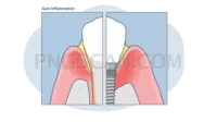Dental Implant #360 cutout from Dental Implant