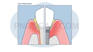 Dental Implant #360 cutout from Dental Implant